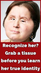 The amazing story of Katie Stubblefield: She became the youngest person to receive a face transplant