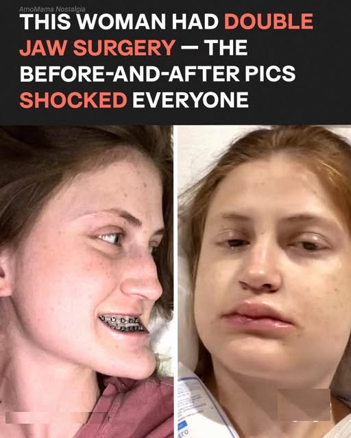 This Girl Underwent Double Jaw Surgery — Before-and-After Photos Left Everyone Speechless